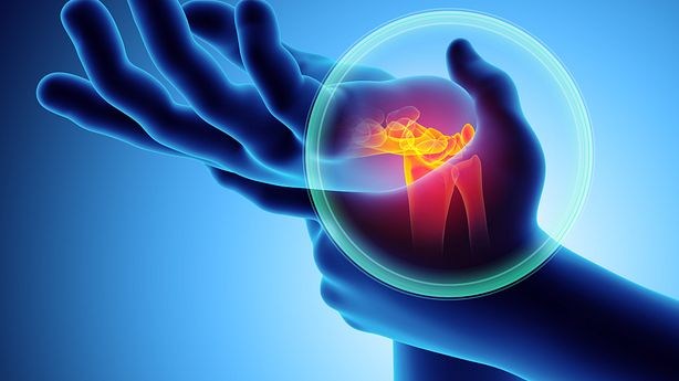 An illustration showing carpal tunnel syndrome.