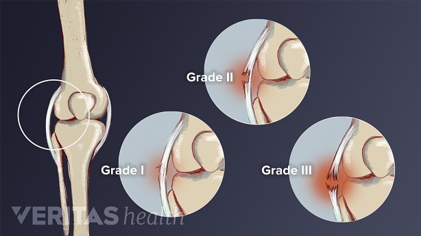 Different grades of knee sprains