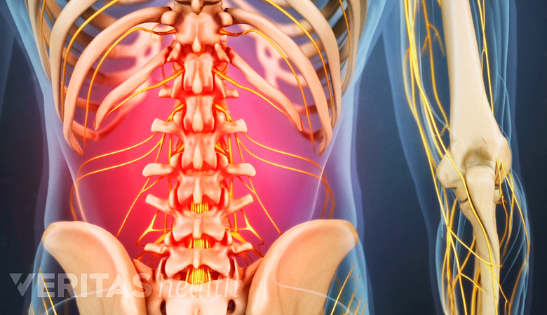 Medical illustration of the lumbar spine highlighted in red, indicating pain, numbness or tingling.