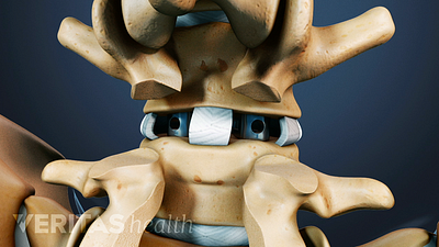 Posterior view of a PLIF implant in the the lumbar spine nerve roots.