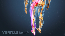 Posterior view of the lower body showing sciatic pain in the legs.