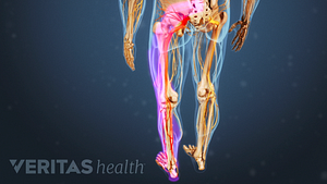 Medical illustration of a skeleton with the sciatic nerve highlighted in red indicating pain, numbness or tingling.