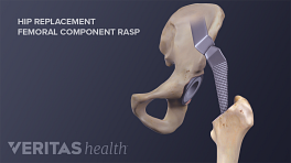 Illustration of a hip replacement with a femoral component rasp