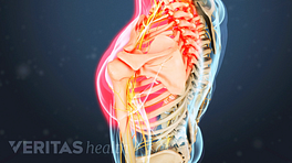 Medical illustration of the upper body, with one shoulder highlighted in red showing nerve pain in the shoulder and arm