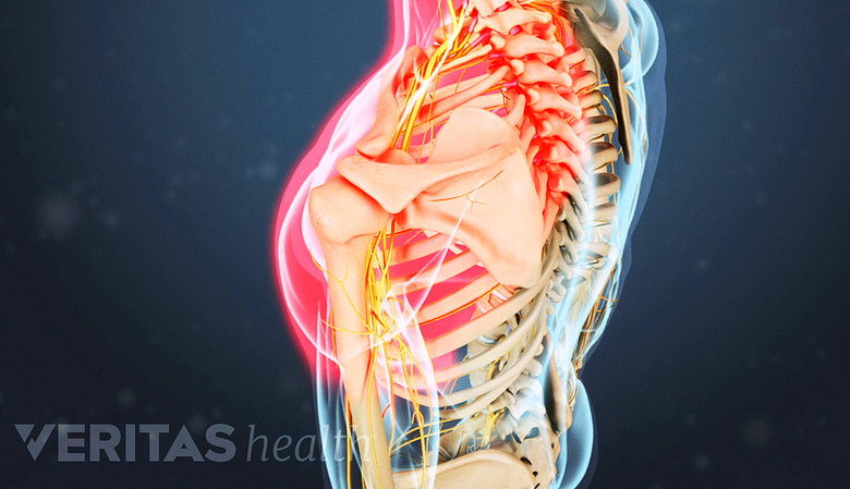 Ilustración médica de la parte superior del cuerpo, con un hombro resaltado en rojo que muestra dolor nervioso en el hombro y el brazo