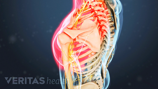 Medical illustration showing radiating pain in the shoulder from cervical radiculopathy