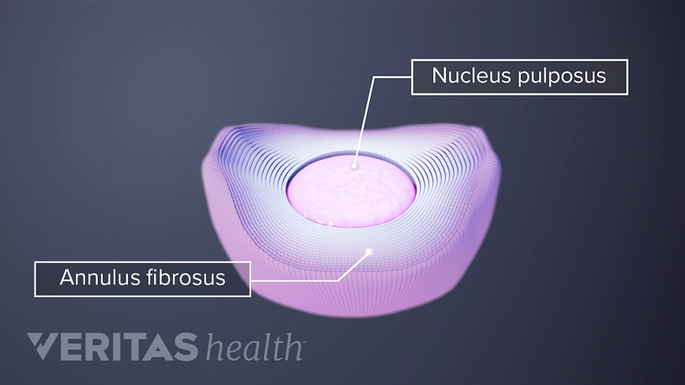 Disc with nucleus pulposus and annulus fibrosus