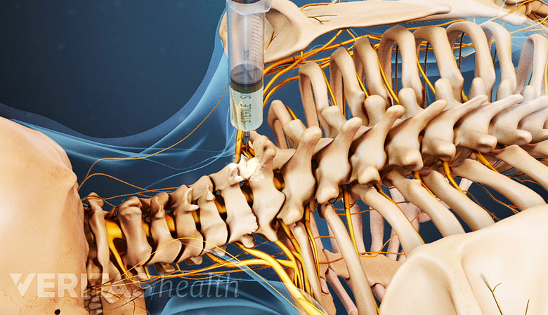 Illustration showing injection injected into the cervical spine.