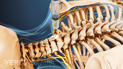 Posterior view of the cervical spine with a steroid injection being injected.