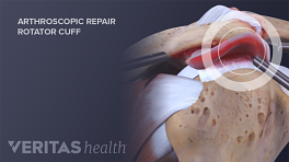 Arthroscopic repair of shoulder impingement