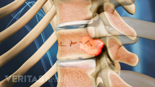 Illustration showing vertebral spine with a tumor highlighted in red and fracture lines on vertebra.