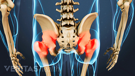 Posterior view of the pelvis highlighting joint pain in the hips.