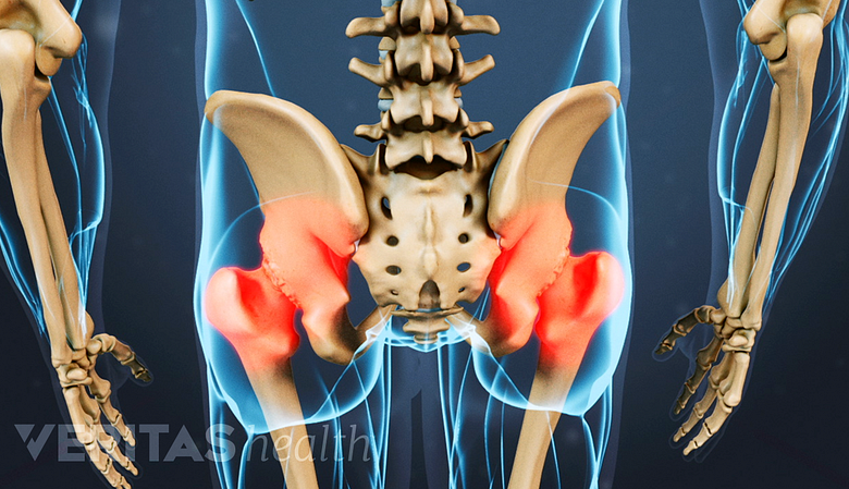 Medical illustration highlighting hip pain in red due to hip osteoarthritis