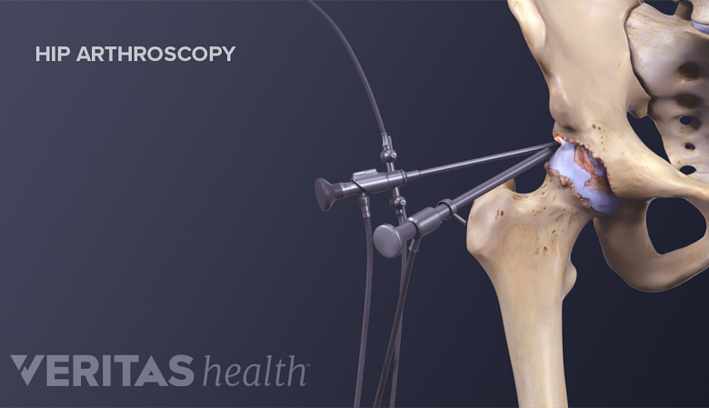 Illustration showing hip anatomy with tools and camera used for hip arthroscopy surgery.