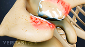 Bone spurs on facet joints.
