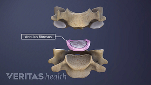 Medical illustration showing the annulus fibrosus that surrounds the cervical disc between two vertebrae