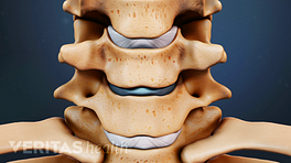 Anterior view of cervical spine showing disc replacement.