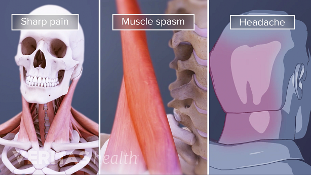 An illustration showing stiff neck muscle pain and haedache.