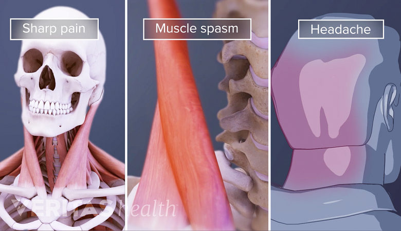 Illustration showing pain, muscle spasm, and headache.