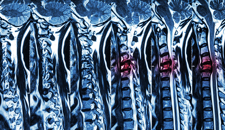 Multiple MRI views of a spine.