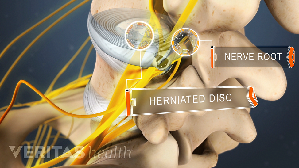 Animated video still showing a herniated disc impinging on a nearby nerve root