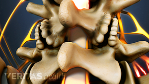 Posterior view of spinal stenosis in the lumber spine.