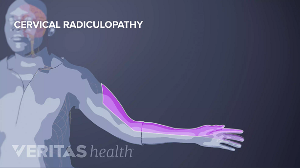 Illustration of cervical pain radiculopathy in the arm.