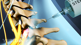 Selective nerve root block being injected into the cervical spine
