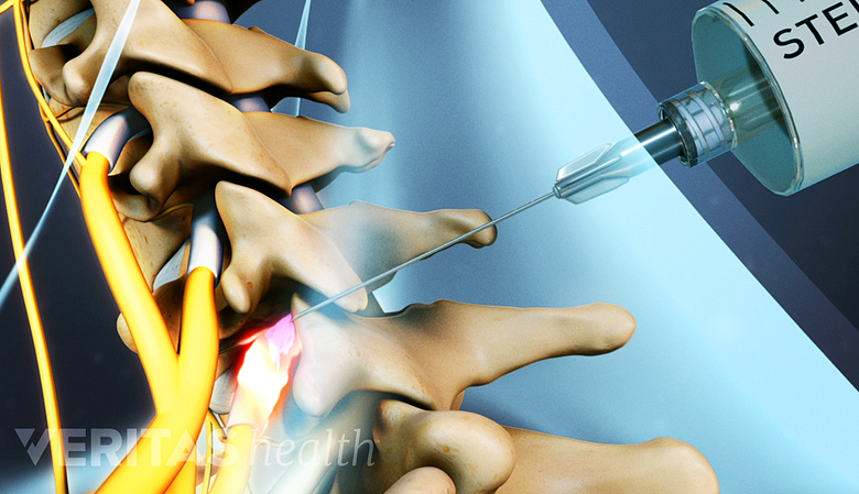 Medical illustration showing cervical spine and a needle injected into it.