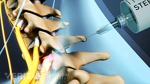 Medical illustration of a cervical selective nerve root block