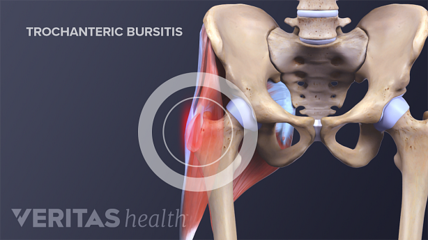 Medical illustration showing trochanteric bursitis in the hip