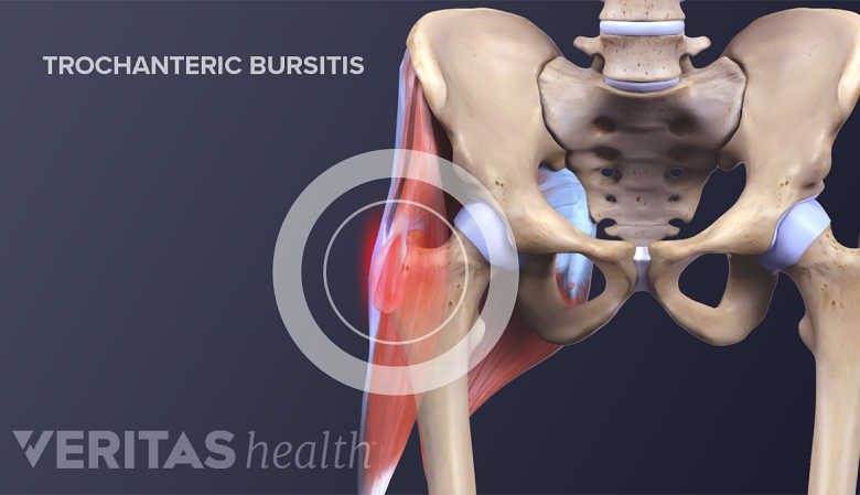 Medical illustration showing trochanteric bursitis in the hip