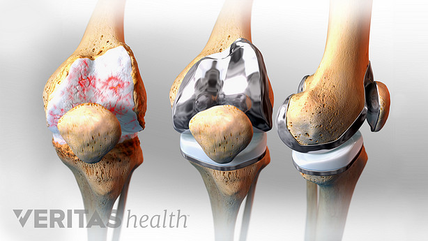 illustration showing the steps of a knee replacement surgery
