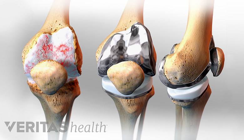 3 stages of a knee replacement. First inset shows a knee with degenerated cartilage, the second inset shows a replaced knee joint, the 3rd inset shows the replaced knee from the side
