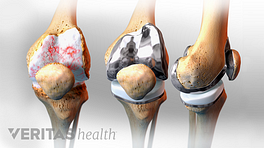 Medical illustration of an arthritic knee joints a front and side view of a replaced knee joint and a re