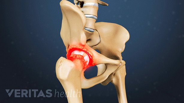Medical illustration of a hip joint showing worn away cartilage, highlighted in red to indicate pain.