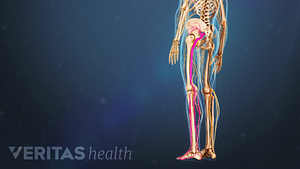 Ilustración médica de un esqueleto. El nervio ciático está resaltado en rojo.
