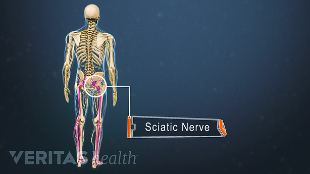 Medical illustration showing sciatic pain radiating along the path of the sciatic nerve