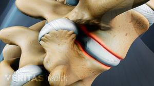 The formation of extra bone on the vertebra.