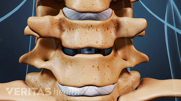 Anterior view of cervical spine showing disc replacement to prevent collapsing.
