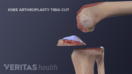 Medical illustration of tibia cuts during total knee replacement