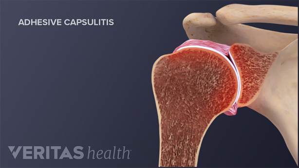 Cross section of normal joint compared to one with frozen shoulder (adhesive capsulitis).