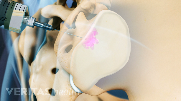 Vista de perfil de la pelvis que muestra una inyección en la articulación sacroilíaca (SI)