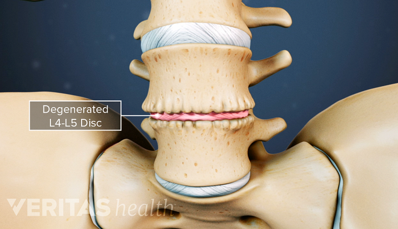 Illustration showing degenerated lumbar vertebra.