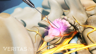 Medial branch nerve injection into a facet joint.