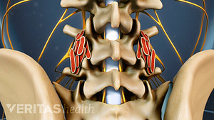 Posterior view of the lumbar spine with a fusion.