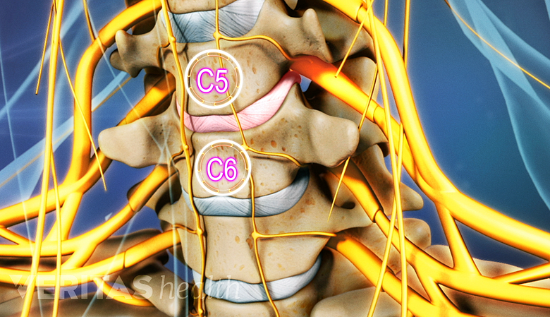 Medical illustration showing the C5-C6 vertebral segment