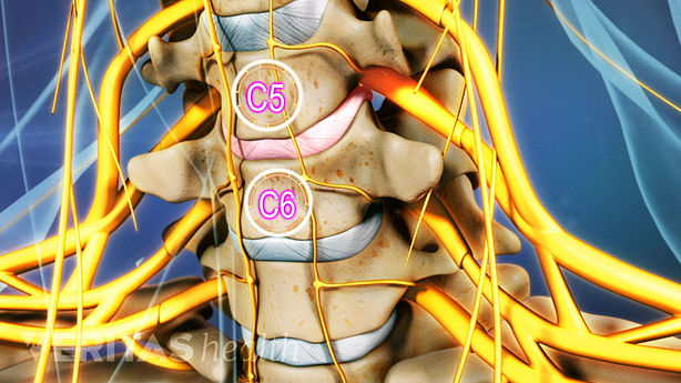 Anterior view of the cervical spine labeling C5-C6.