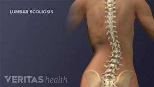 Posterior view of the adult spine showing lumbar scoliosis.