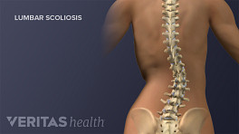 Posterior view of the adult spine showing lumbar scoliosis.